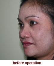 plastic_surgery_augmentation_rhinoplasty